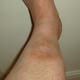 Illustration for article titled How A Softball Almost Killed This Mans Foot